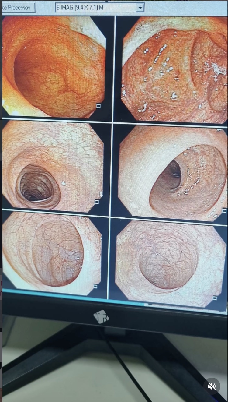 Imagens de colonoscopia ilustrando sinais de alerta do intestino grosso