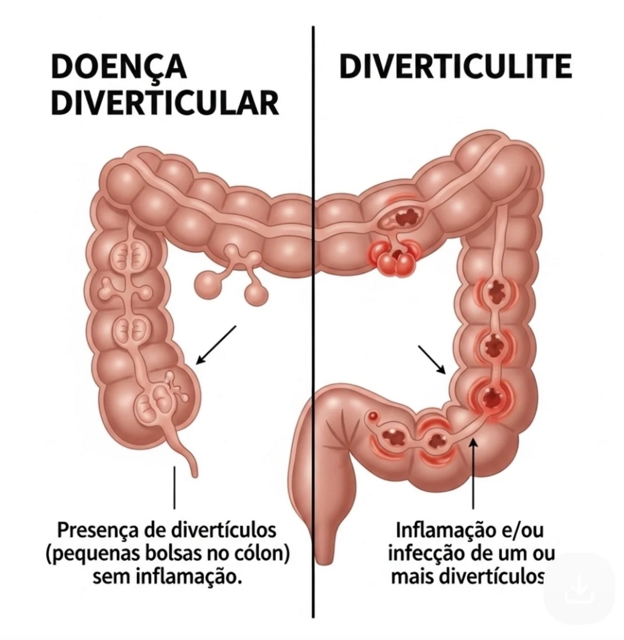 Ilustração comparando doença diverticular e diverticulite no cólon